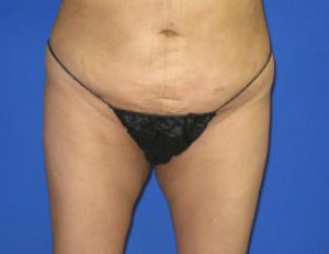 VASER Liposuction Before & After Patient #1123