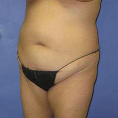 VASER Liposuction Before & After Patient #1123