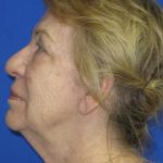 Renuvion Skin Resurfacing Before & After Patient #979