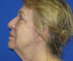 Renuvion Skin Resurfacing Before & After Patient #979