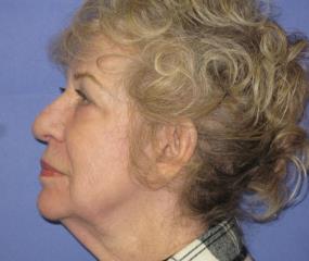 Renuvion Skin Resurfacing Before & After Patient #979