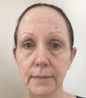 Renuvion Skin Resurfacing Before & After Patient #995