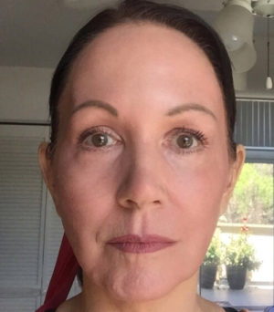 Renuvion Skin Resurfacing Before & After Patient #995