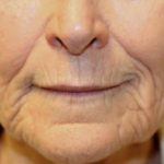 Renuvion Skin Resurfacing Before & After Patient #1005