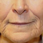 Renuvion Skin Resurfacing Before & After Patient #1005