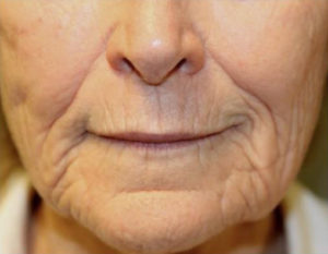 Renuvion Skin Resurfacing Before & After Patient #1005