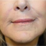 Renuvion Skin Resurfacing Before & After Patient #1005