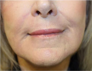 Renuvion Skin Resurfacing Before & After Patient #1005