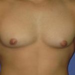 Gynecomastia Before & After Patient #1323