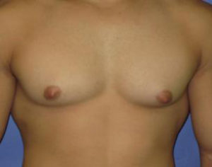 Gynecomastia Before & After Patient #1323