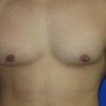 Gynecomastia Before & After Patient #1323