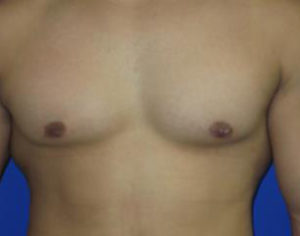 Gynecomastia Before & After Patient #1323