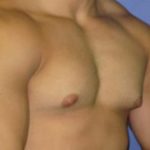 Gynecomastia Before & After Patient #1323