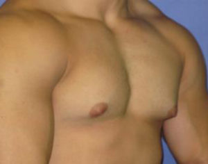 Gynecomastia Before & After Patient #1323