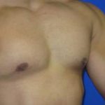 Gynecomastia Before & After Patient #1323