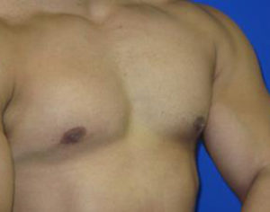 Gynecomastia Before & After Patient #1323