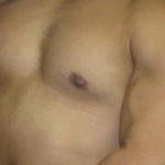 Gynecomastia Before & After Patient #1323