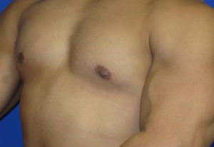 Gynecomastia Before & After Patient #1323