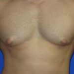 Gynecomastia Before & After Patient #1330