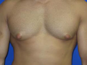 Gynecomastia Before & After Patient #1330