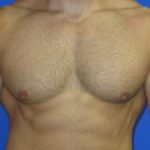 Gynecomastia Before & After Patient #1330