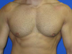 Gynecomastia Before & After Patient #1330