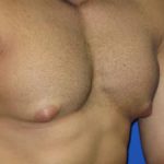 Gynecomastia Before & After Patient #1330