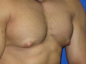 Gynecomastia Before & After Patient #1330