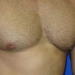 Gynecomastia Before & After Patient #1330