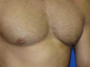 Gynecomastia Before & After Patient #1330