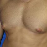 Gynecomastia Before & After Patient #1330