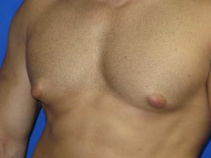 Gynecomastia Before & After Patient #1330