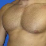 Gynecomastia Before & After Patient #1330