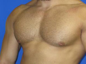 Gynecomastia Before & After Patient #1330