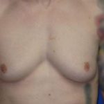 Gynecomastia Before & After Patient #1337