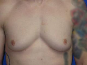 Gynecomastia Before & After Patient #1337