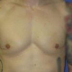 Gynecomastia Before & After Patient #1337