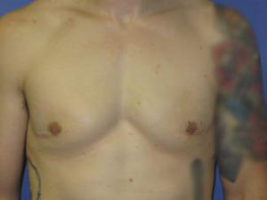 Gynecomastia Before & After Patient #1337