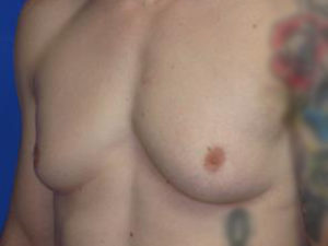 Gynecomastia Before & After Patient #1337