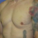 Gynecomastia Before & After Patient #1337