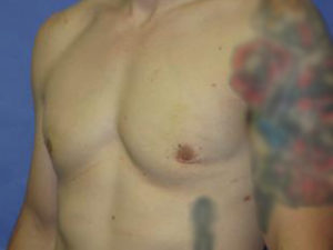 Gynecomastia Before & After Patient #1337