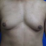 Gynecomastia Before & After Patient #1344