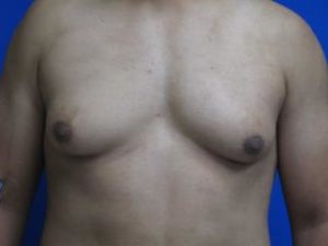 Gynecomastia Before & After Patient #1344