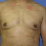 Gynecomastia Before & After Patient #1344