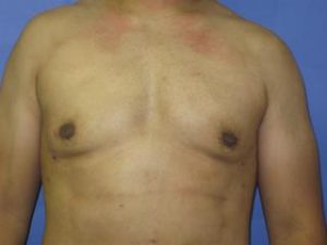 Gynecomastia Before & After Patient #1344