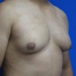 Gynecomastia Before & After Patient #1344