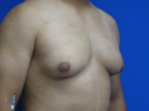 Gynecomastia Before & After Patient #1344