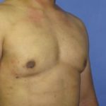 Gynecomastia Before & After Patient #1344