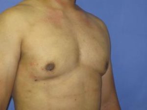 Gynecomastia Before & After Patient #1344