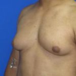 Gynecomastia Before & After Patient #1344